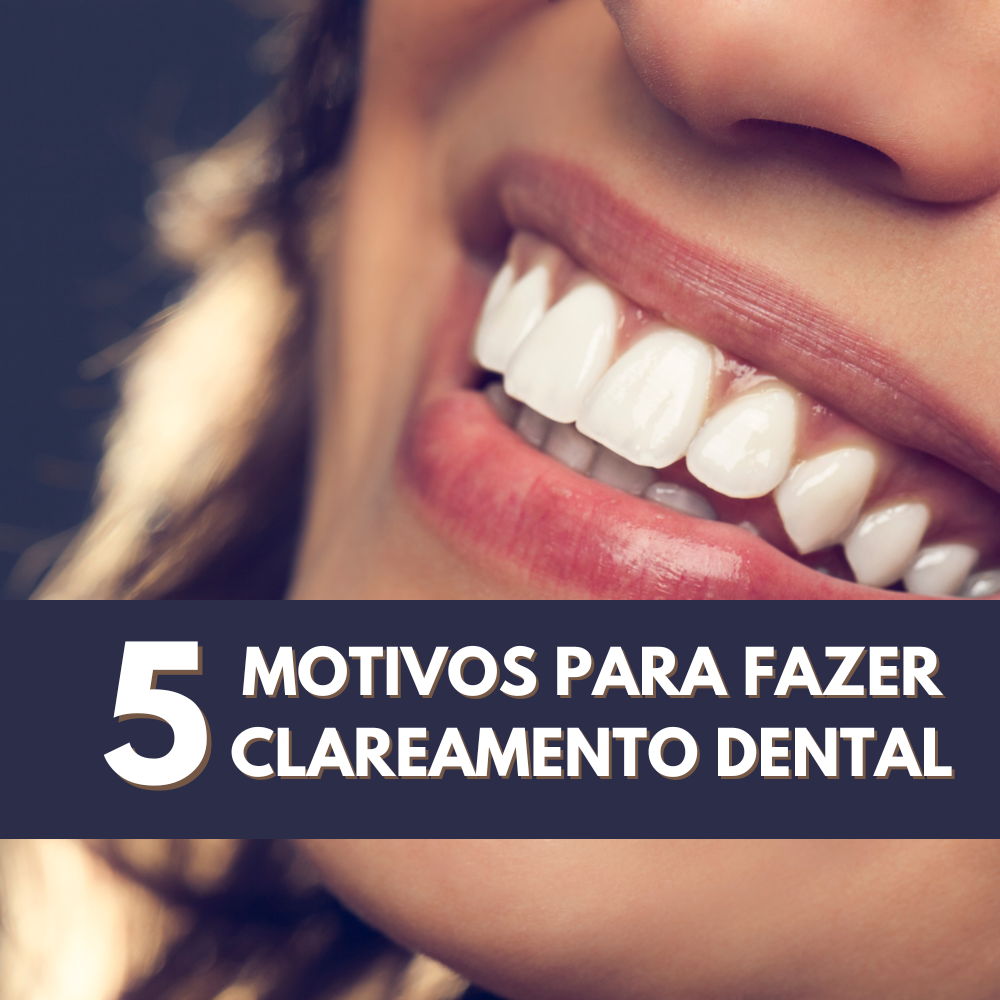 veja agora 5 Motivos Para Fazer Clareamento Dental